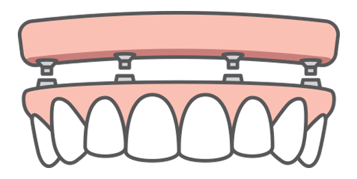 Full arch replacement