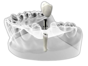 virtual model of a single dental implant being placed