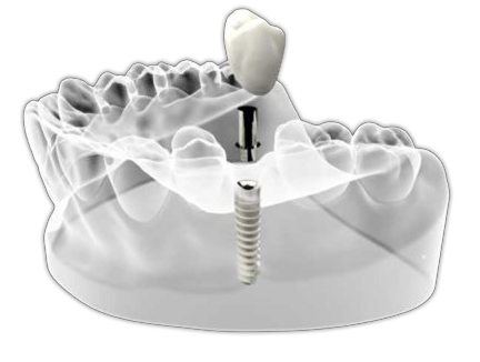 virtual model of a single dental implant being placed