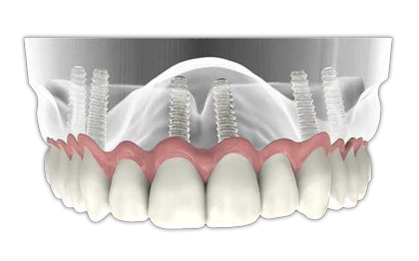 virtual model of full-arch dentures supported with six dental implants