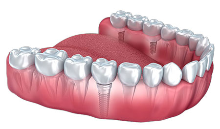 virtual model of a dental implant surrounded by natural teeth