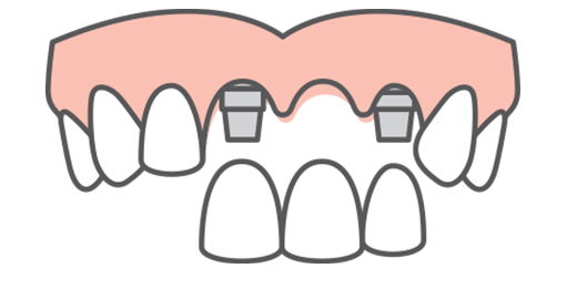 Multiple teeth replacement