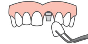 Single tooth replacement