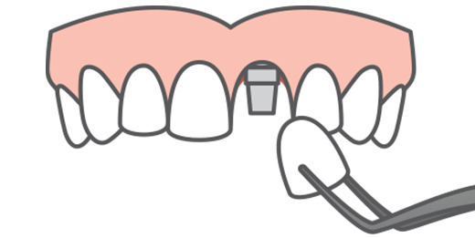 Single tooth replacement