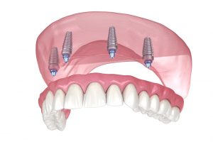 3D model of All-on-4 implants