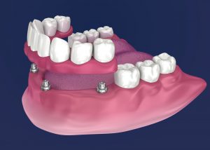 implant partial dentures