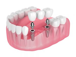 implant dental bridge