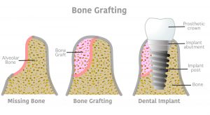 diagram of bone graft for dental implants