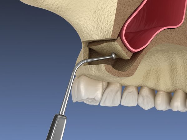 3d render of a sinus lift procedure